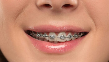 Gerade Zähne Ohne Zahnspange? Dentilus