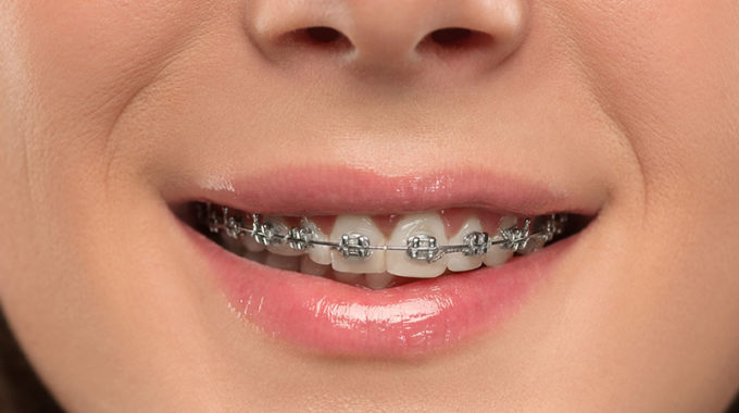 Gerade Zähne Ohne Zahnspange? Dentilus