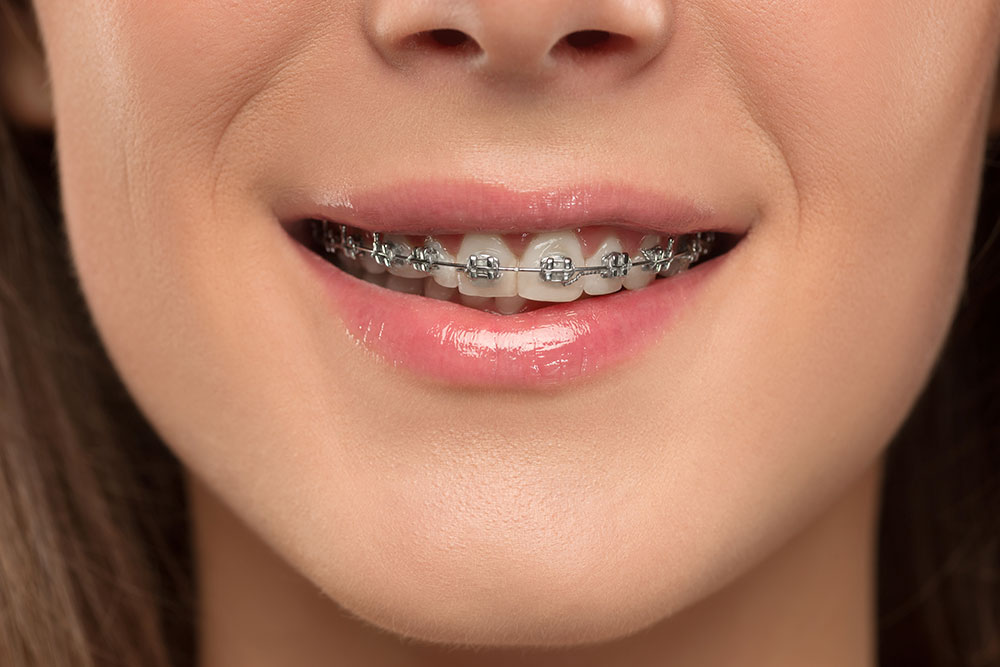 Gerade Zähne ohne Zahnspange? Dentilus