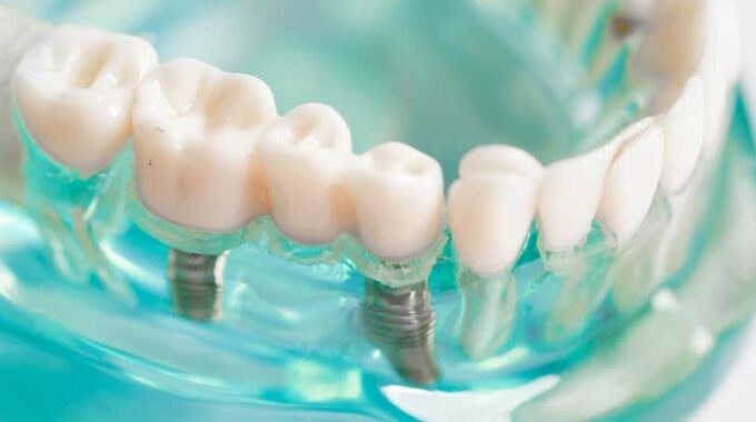 Zahnimplantate | Implantologie Dentilus