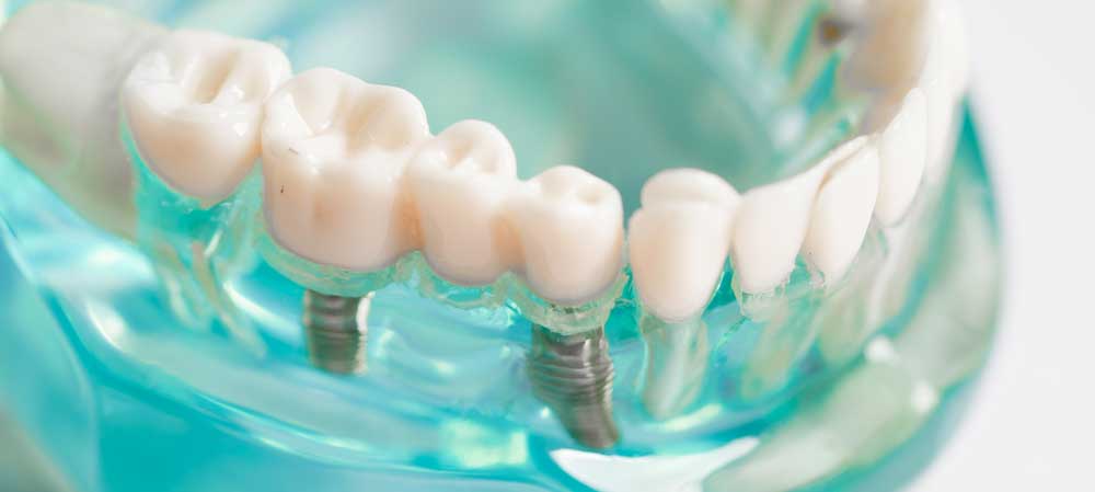 Zahnimplantate | Implantologie Dentilus