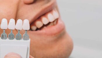 Zahnverfärbungen entfernen: Ursachen & Lösungen | Dentilus