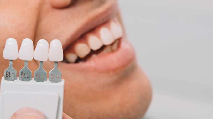 Zahnverfärbungen entfernen: Ursachen & Lösungen | Dentilus